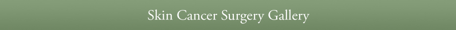 Skin Cancer Surgery Gallery